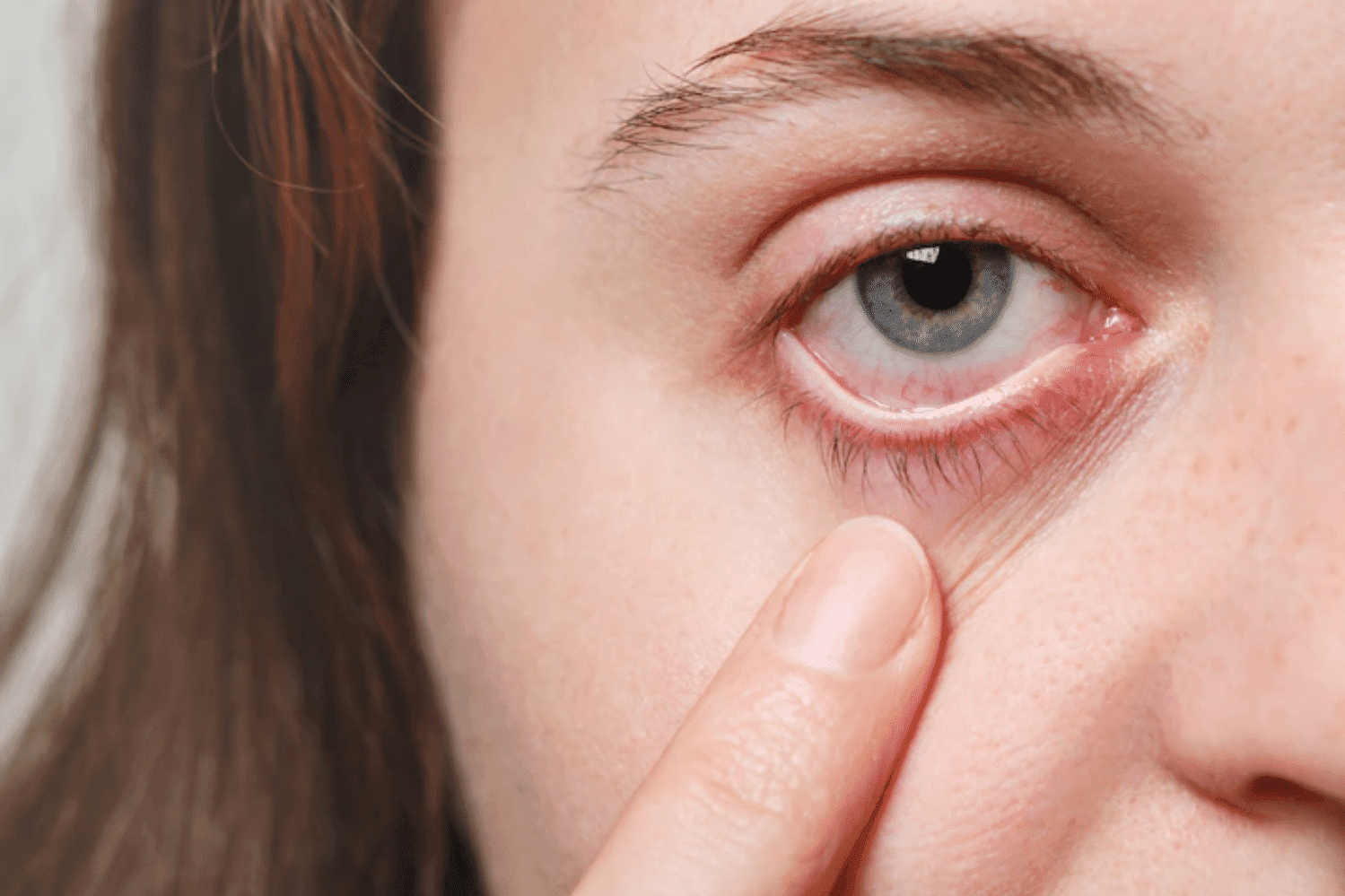 Síndrome do olho seco