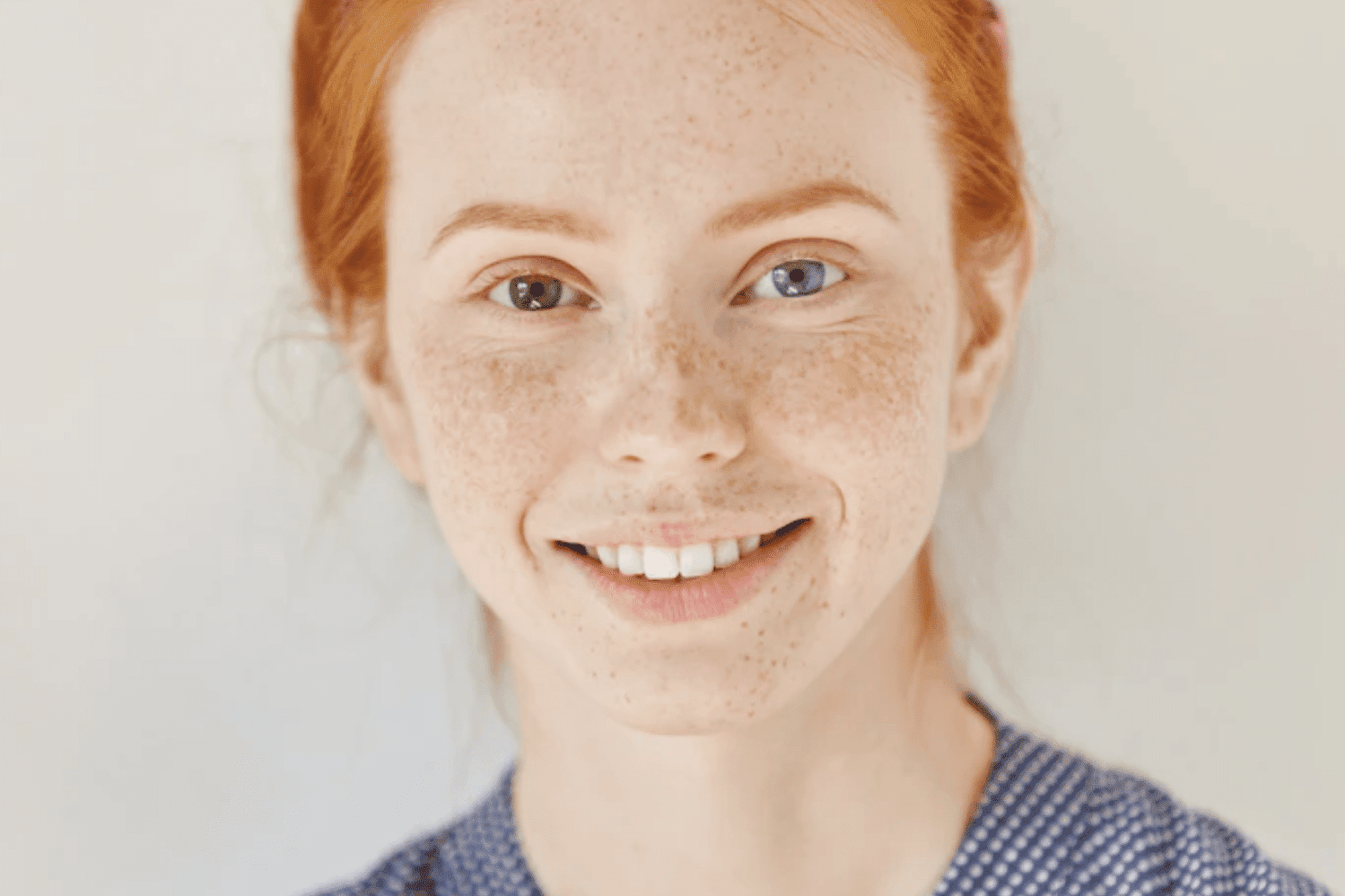 Heterocromia ocular: a variação de cores dos olhos em uma mesma pessoa