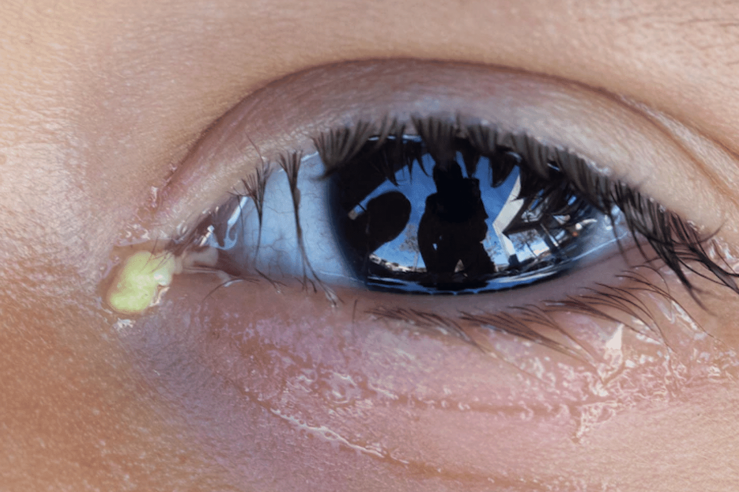 Olhos lacrimejando em excesso, o que pode ser?