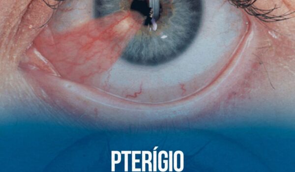 Pterígio-_01